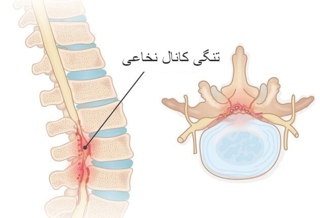 تنگی کانال نخاع