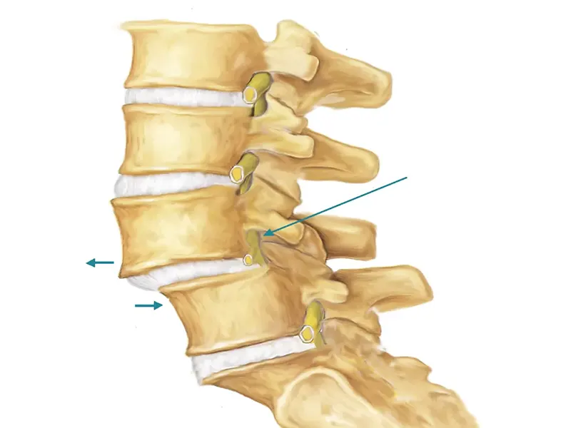 لقی مهره کمری